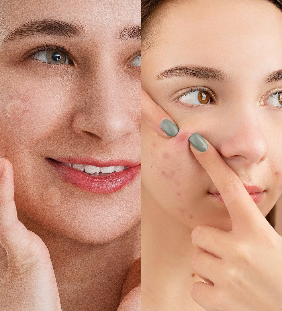 Oxy Pimple Patch